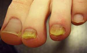 灰指甲-甲癬-指甲變色-指甲增厚變脆-甲床剝離-皮膚專科-灰指甲怎麼辦-灰指甲雷射